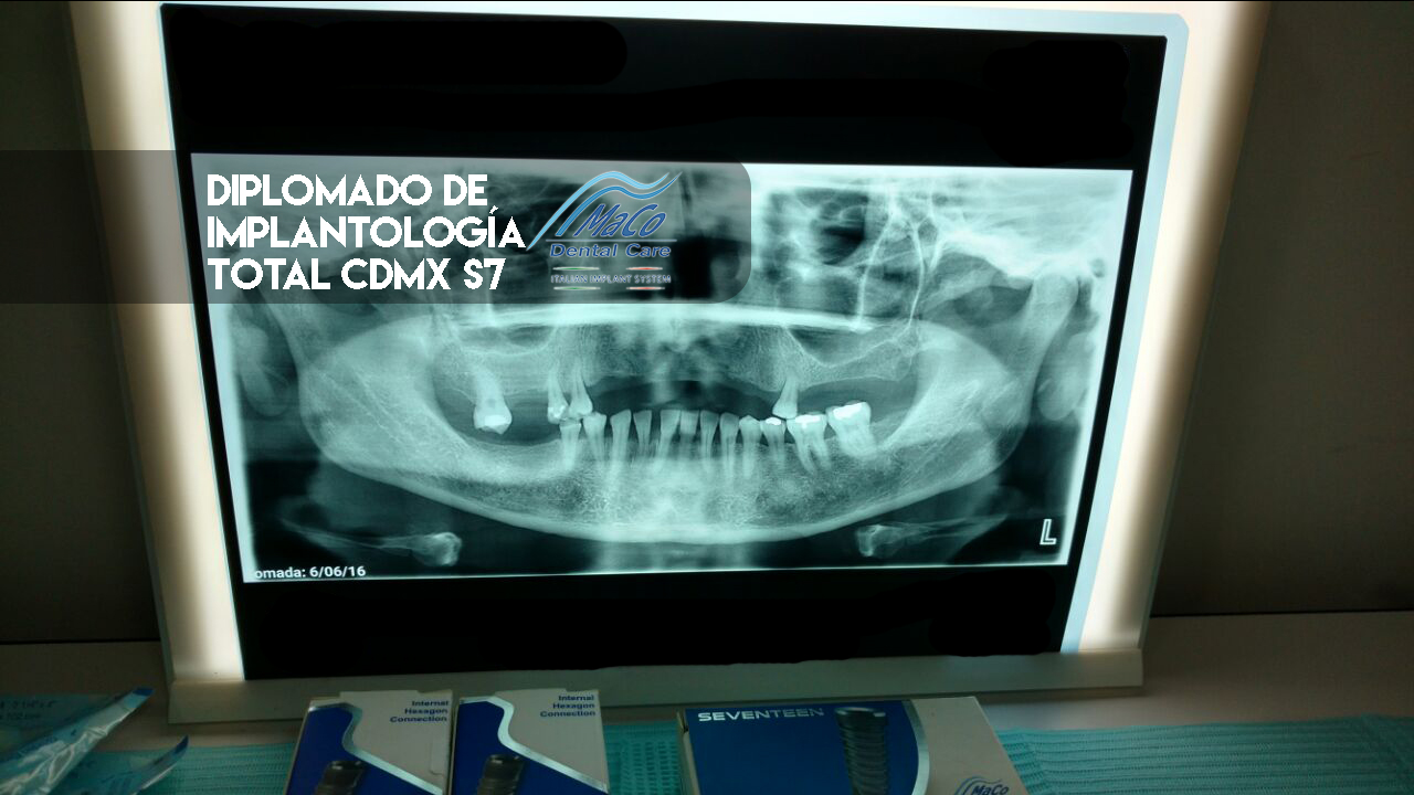 Diplomado de implantología total s7